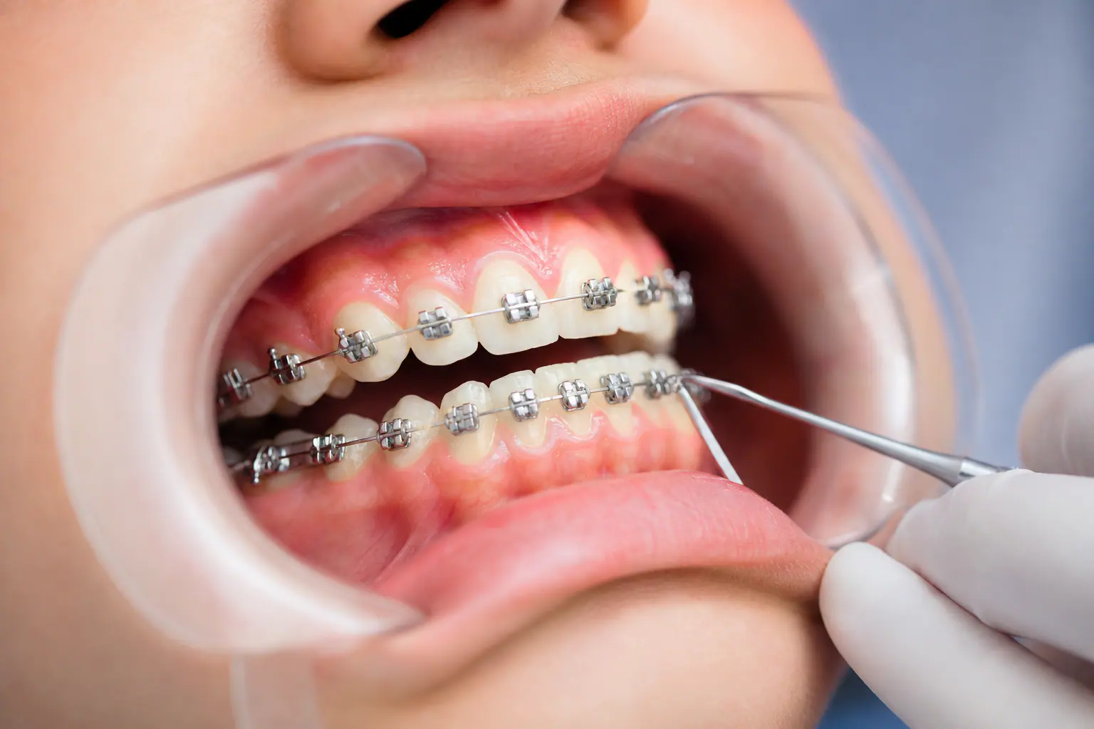 تقويم معدني لعلاج العضة العميقة — أبوظبي