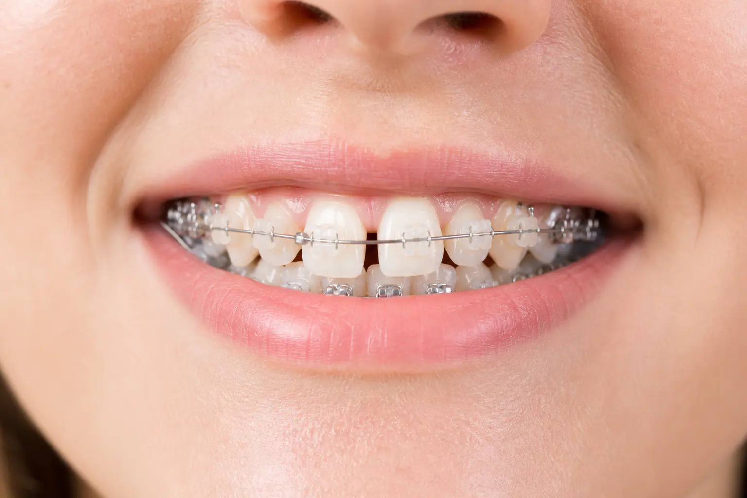 Metal and ceramic braces to close tooth gaps - Abu Dhabi