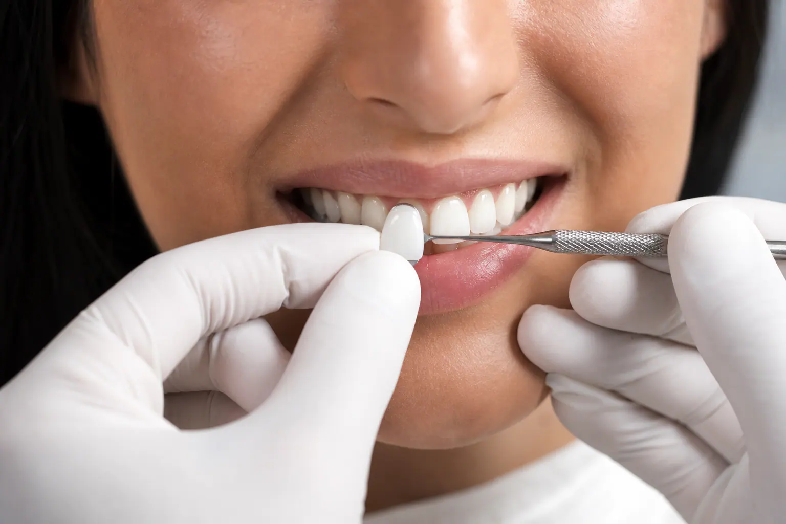 Dental veneer installation — minute details of porcelain veneers in a cosmetic dentistry clinic